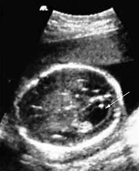 Isolated Mild Fetal Ventriculomegaly Adc Fetal And Neonatal Edition