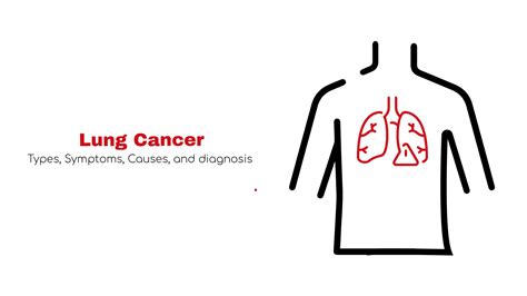 Lung Cancer ~ Statcardiology