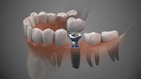 Dental Implants For Missing Teeth Rb Dental Excellence