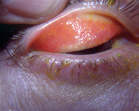Contact Lens Under Eyelid Anger Is A Normal