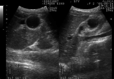 Abdominal Ultrasonography Revealed An Abnormally Large Floating