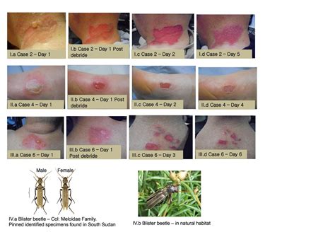 Blister Beetle Dermatitis Caused By Cantharidin In South Sudan In Op