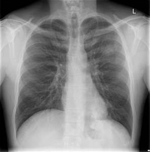 Diagram Pneumonia X Ray