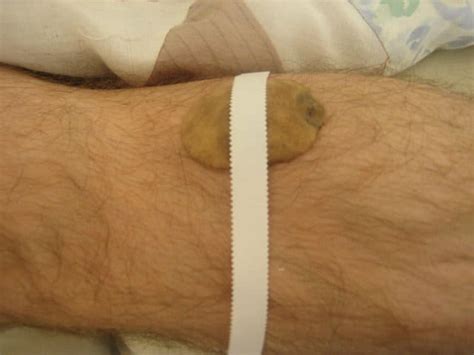 Most nonvenomous spider bites can be treated at home as you would a typical insect bite and will heal within a week or so. How to Heal a Spider Bite with a Potato | Don't Waste the ...