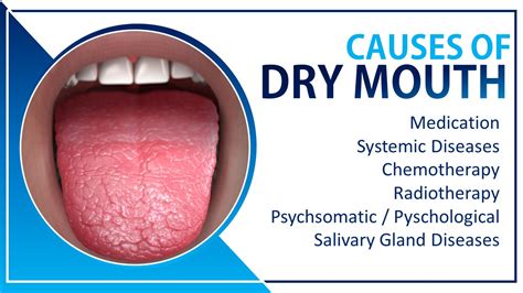 Extreme Dry Mouth At Night