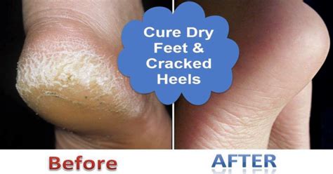 How To Fix Dry Scaly Feet