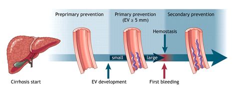 Current Management Of The Complications Of Portal Hypertension