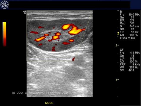 Ultrasound Imaging Normal And Enlarged Lymph Nodes