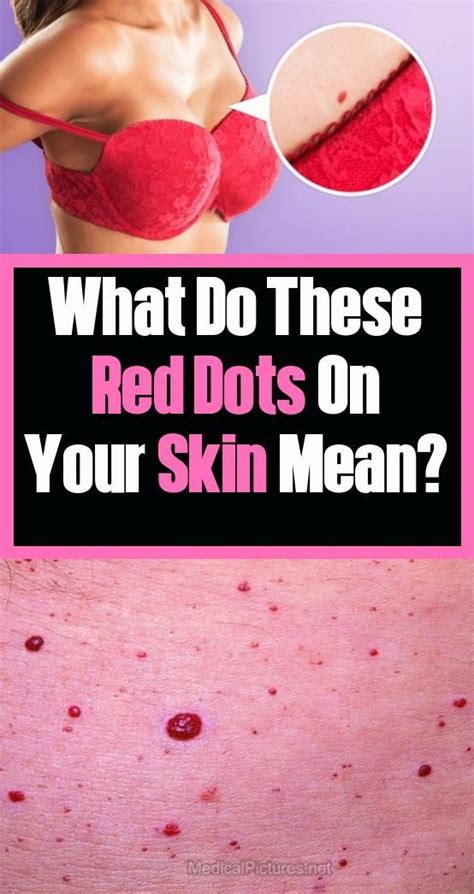What Do The Red Dots Mean To Your Skin Healthyfats Healthylifestyle