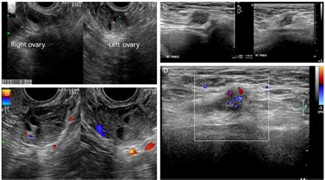 Transvaginal Ultrasonographic Findings Of The Adnexa And Inguinal Mass