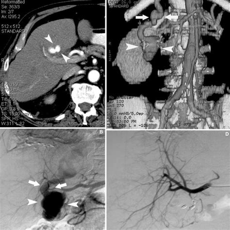 Ruptured Splenic Artery Pseudoaneurysm In A 56 Year Old Woman A Axial