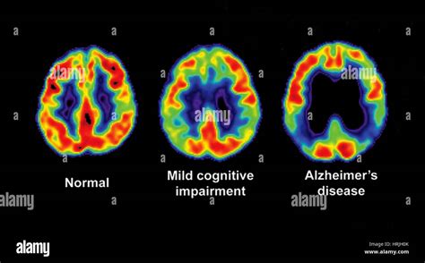 Normal Impaired And Alzheimer Brain Pet Scans Stock Photo Alamy