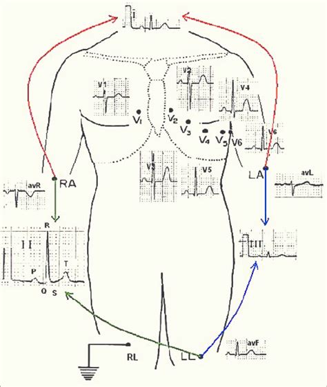 Shows Anatomical Placement Of The Electrodes And The Ecg Signal