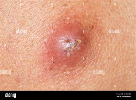 Infected Sebaceous Cyst On The Skin Of A 67 Year Old Female Patient A