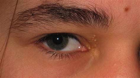 Treatment For Lump Inside Eyelid Chalazion Eyelid Cyst Mr David
