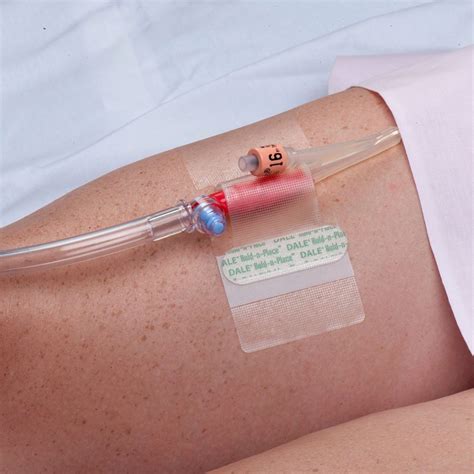 Hold N Place Adhesive Patch Foley Catheter Holder Ghc Usa Global