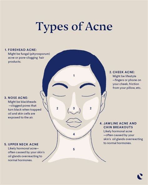 What To Know About Acne Face Mapping Curology Akne Abdecken Pickel