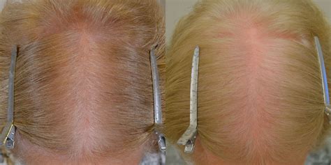 Within this menu, we have carefully selected the most relevant pages for women experiencing hair loss. Finasteride (Females) Before & After Photos - Hair ...