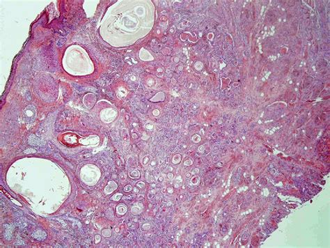 Microcystic Adnexal Carcinoma—diagnostic Criteria And Therapeutic