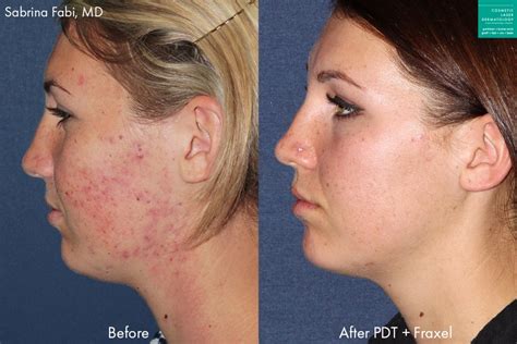 Photodynamic Therapy Acne Treatment San Diego Ca Clderm