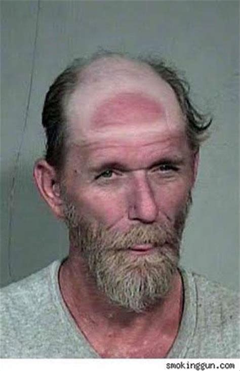 Funny Sunburns Gallery Ebaums World