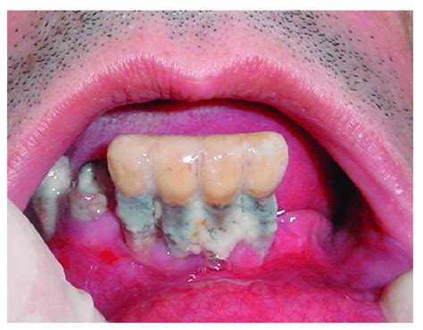 Severe Gum Disease