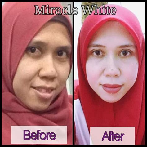 This lightweight intensive brightening cream, enriched with a remarkably lightening and moisturizing complex, is formulated to reduce over excessive melanin and lighten skin pigmentation. Miracle White Advance Repair Brighte (end 2/27/2019 9:15 AM)