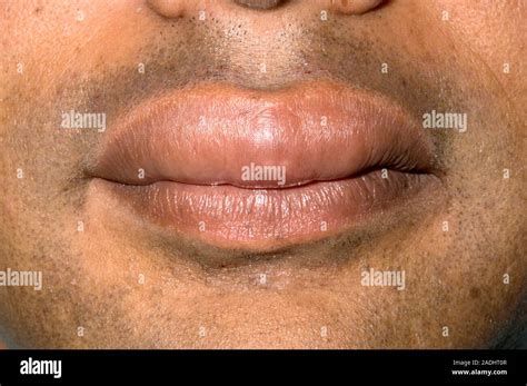 Model Released Swollen Lip Of A 40 Year Old Man Caused By Angioedema