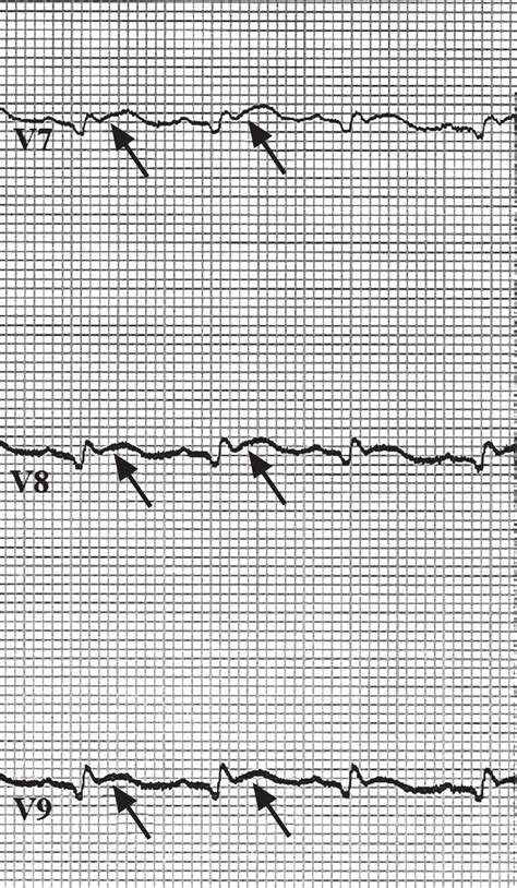 Electrocardiogram Shows St Segment Elevation In Posterior Leads V 7