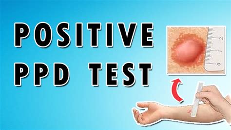 What Does A Positive Tb Test Look Like Pictures 17 Most Correct
