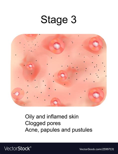 Stage 3 Development Acne Inflamed Skin Royalty Free Vector