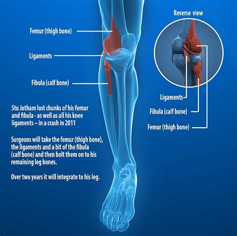 Left Leg Ligaments Ankle Ligament Surgery A Wide Variety Of Leg Ligaments Options Are