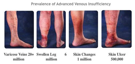 Varicose Veins Signs And Symptoms Inovia Vein Specialty Center