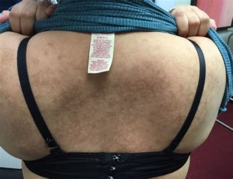 Derm Dx Itchy Hyperpigmented Rash On The Upper Back Dermatology Advisor