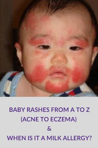 Common Baby Rashes Acne To Eczema Is It A Milk Allergy Baby Rash