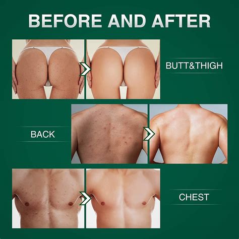 Buy Butt & Thigh Anti Acne Cream,Body Acne Cream,Removing Acne,Pimples