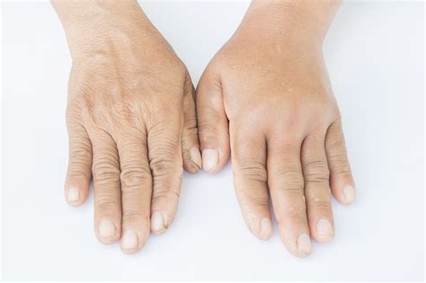Rash Swelling On Arm Printable Templates Protal