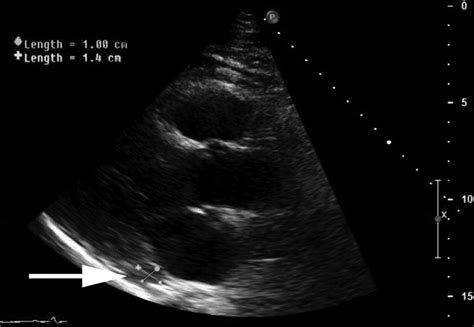 Quantitative coronary angiography remains the reference standard for assessing coronary anatomy, measuring anatomic severity of the stenotic lesion and assisting in the process of intracoronary interventions. Rare Case of an Unroofed Coronary Sinus | Circulation