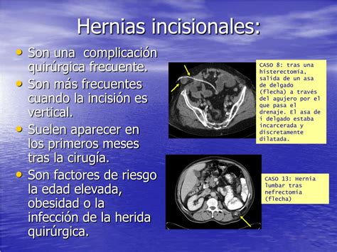Ppt DiagnÓstico De Las Hernias Abdominales Y Sus Complicaciones En La