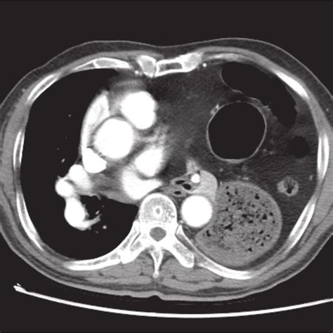 Abdomen Computed Tomography Revealed Focal Pancreatic Parenchymal