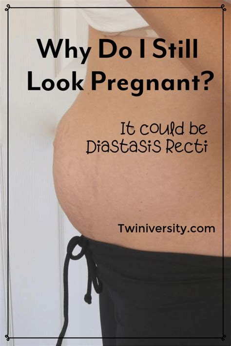 Why Do I Still Look Pregnant It Could Be Diastasis Recti Diastasis