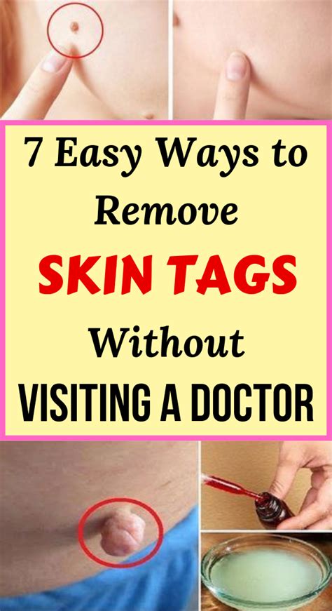 7 easy ways to remove skin tags without visiting a doctor
