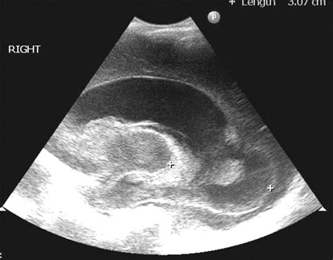 Management Of Posthaemorrhagic Ventricular Dilatation Adc Fetal