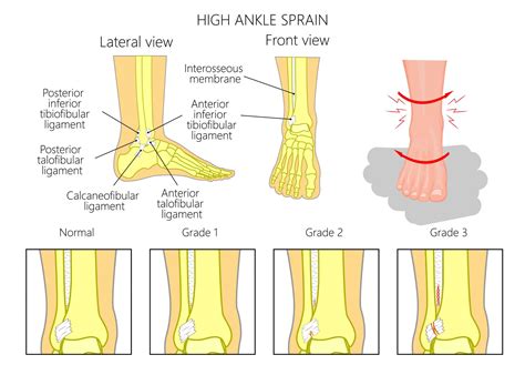 High Ankle Sprain Faqs Our Experts Answer All Your Questions