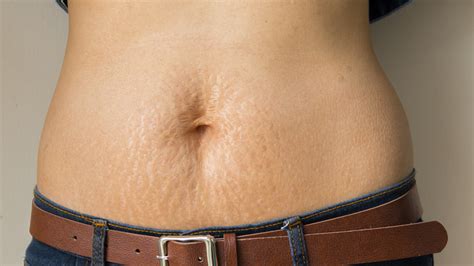 The Sneaky Trick That Can Help You Cover Up Stretch Marks