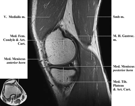 Knee Muscle Anatomy Mri Mri Knee Joint Anatomy Knee Muscle Anatomy