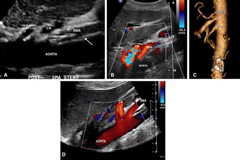 Variant Mesenteric Anatomy Replaced Left Hepatic Artery Lha And Left Download Scientific