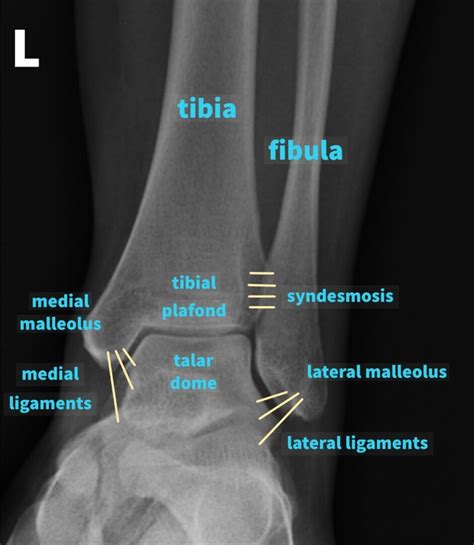 Ankle X Ray Interpretation Ankle Fracture Geeky Medics