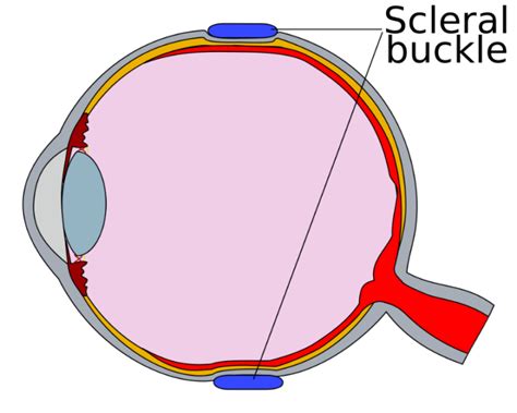 Retinal Detachment Ophthalmology Geeky Medics
