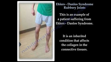 Elhers Danlos Syndrome Everything You Need To Know Dr Nabil